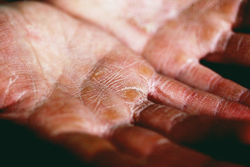 Close-up of dry cracked hands affected by hand eczema being moisturized with natural salve